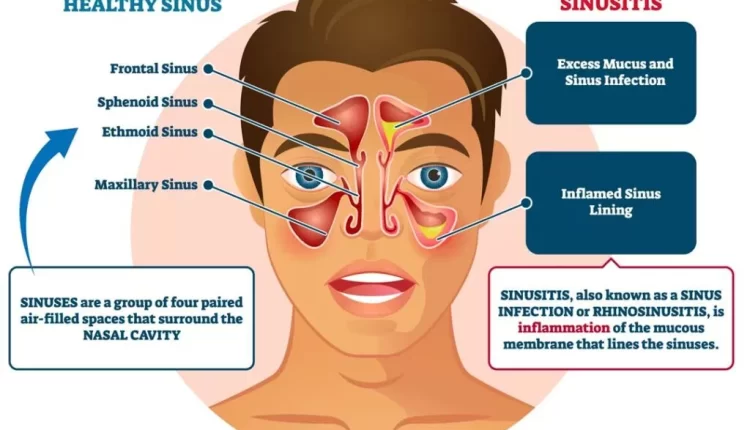 أفضل علاج منزلي لانسداد الأنف والتهاب الجيوب الأنفية