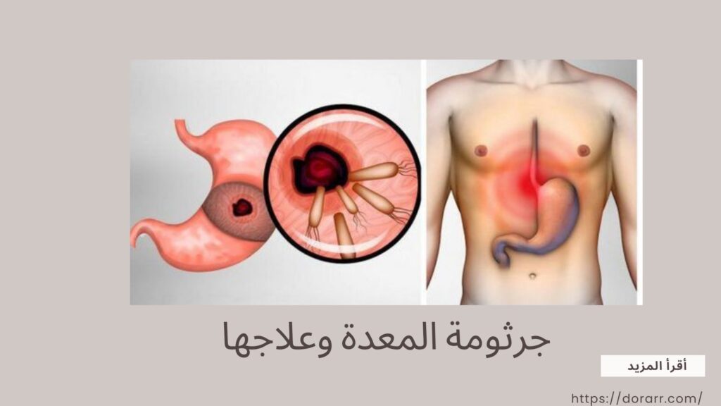 جرثومة المعدة وعلاجها